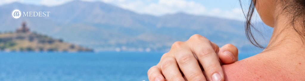 Sunburn