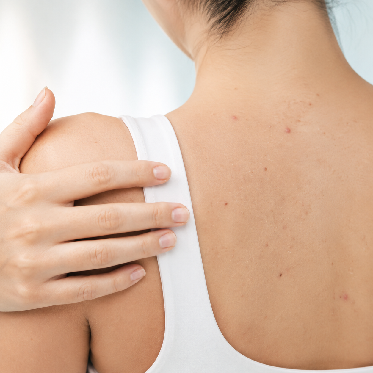 Back and Decollete Acne in Summer: Treatment