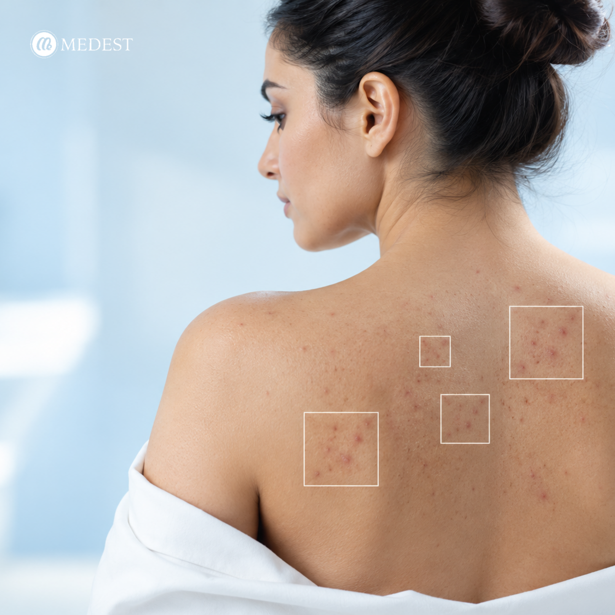 Dark Marks From Acne and Sunburn: Care and Options for Correction