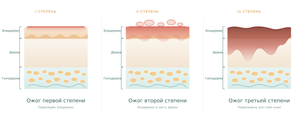 Ожоги кожи от солнца